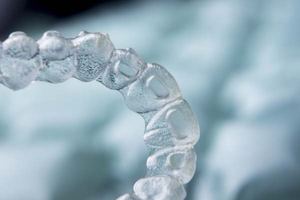 Five Advantages Of Clear Aligners