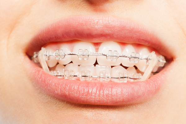 FAQs About Clear Braces Treatment