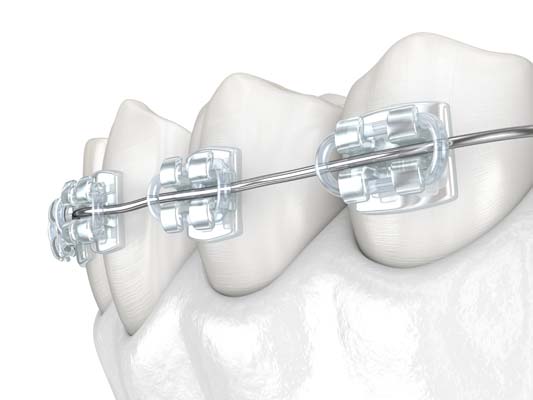 A Comprehensive Guide To Clear Braces For Adults And Teens