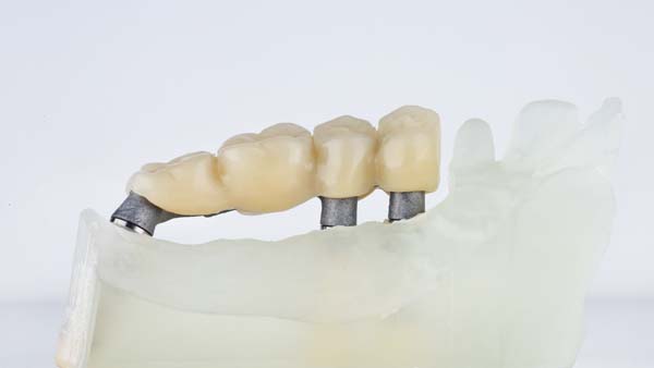 How Dental Bridges Can Improve Your Smile