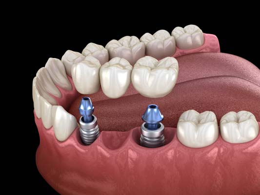 How Long Do Dental Bridges Last?