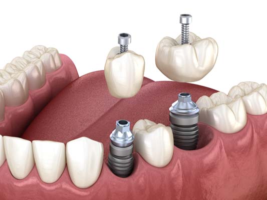 How Traditional Dental Crowns And Implant Crowns Differ