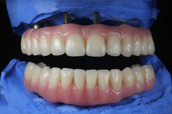 A Brief Comparison Between Implant Supported Dentures And Traditional Dentures