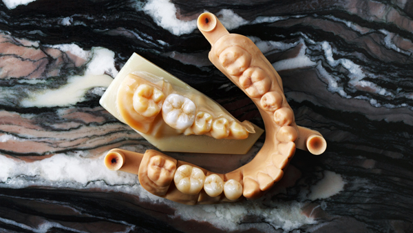Implant Supported Dentures Guide: Process, Benefits, And Care