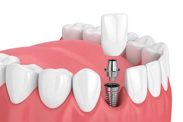 Mini Vs Regular Dental Implants