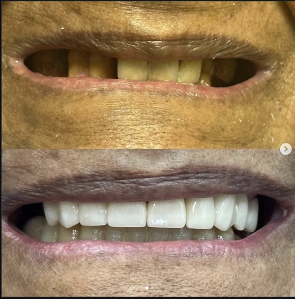 Crowns & Bridges Transformation