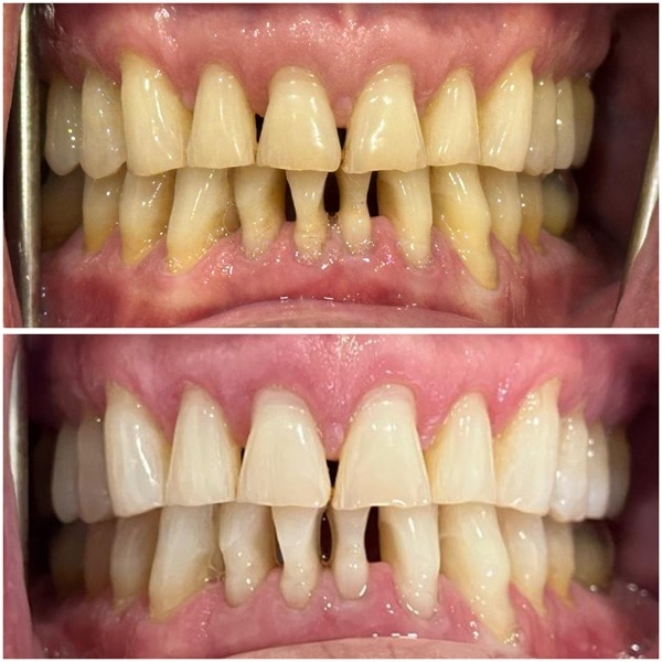 Whitening B&A