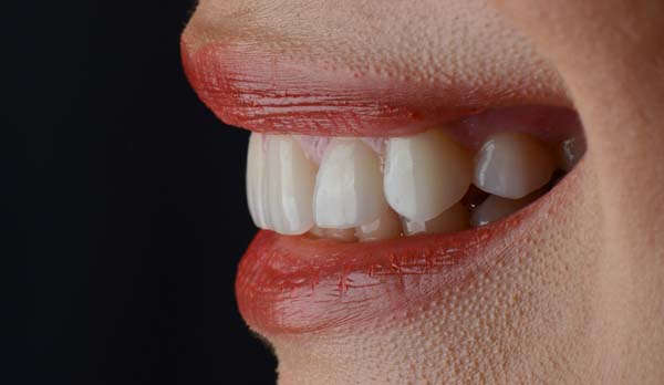 Smile Makeover Options From Your General Dentist