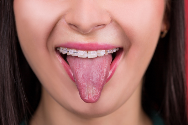 Why A Dentist May Recommend Braces For Teeth Straightening